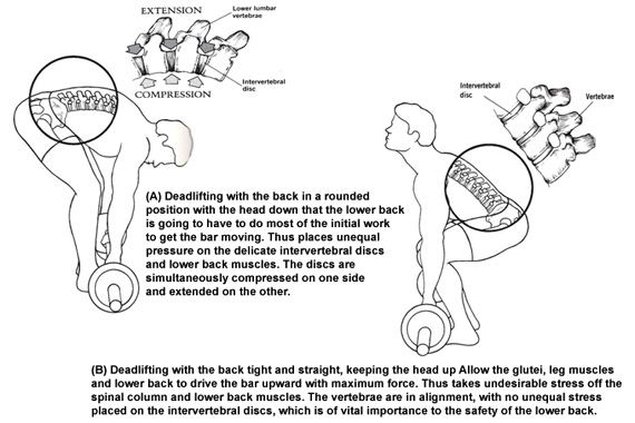 硬举训练指南：硬举圆背增加椎间盘突出的风险