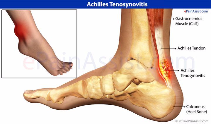 足跟疼痛阿基里斯腱疼痛 跟腱炎 Achilles tendinitis跑步常见伤害损伤预防治疗