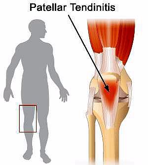 肌肉解剖图解髌骨肌腱炎膝盖周围肌肉大腿小腿