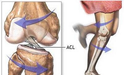 Anterior Cruciate Ligament|ACL|前交叉韧带 - 运动医学知识-医学百科
