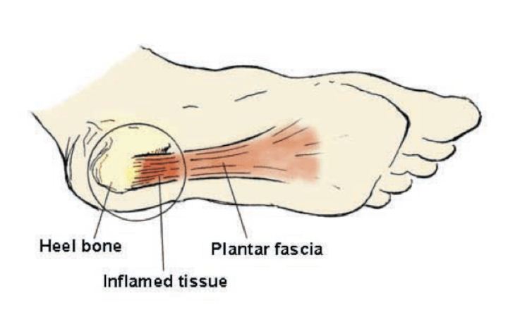 Plantar fasciitis|足底筋膜炎 - 运动损伤知识